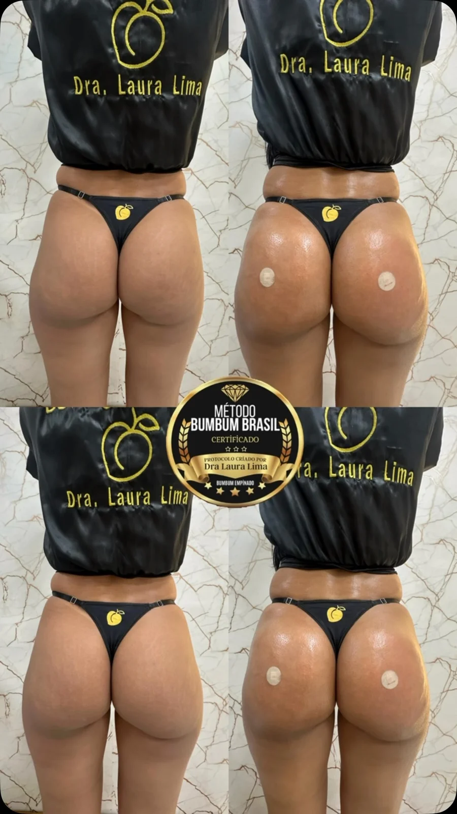 Antes e depois de harmonização glútea