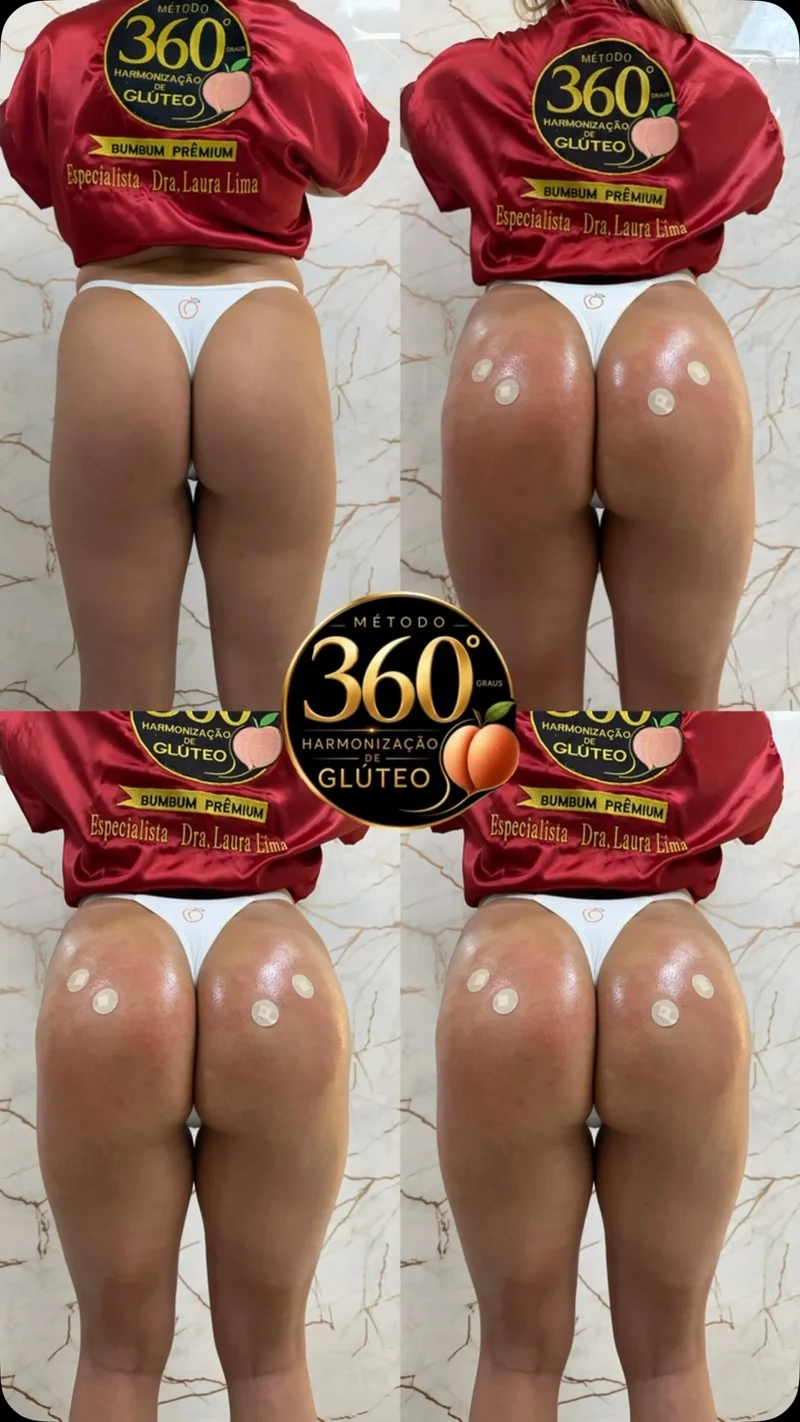 Antes e depois de harmonização glútea