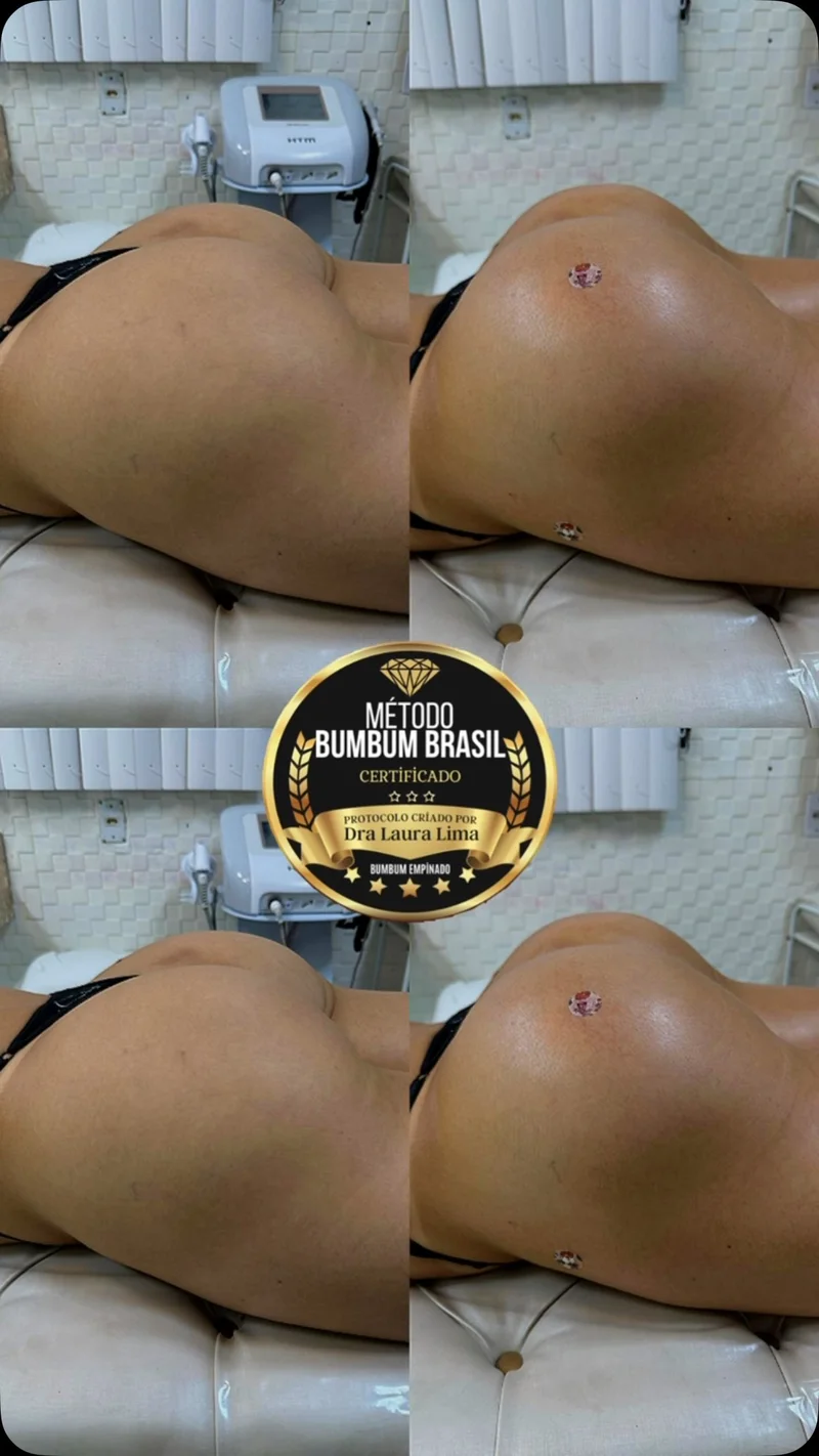 Antes e depois de harmonização glútea