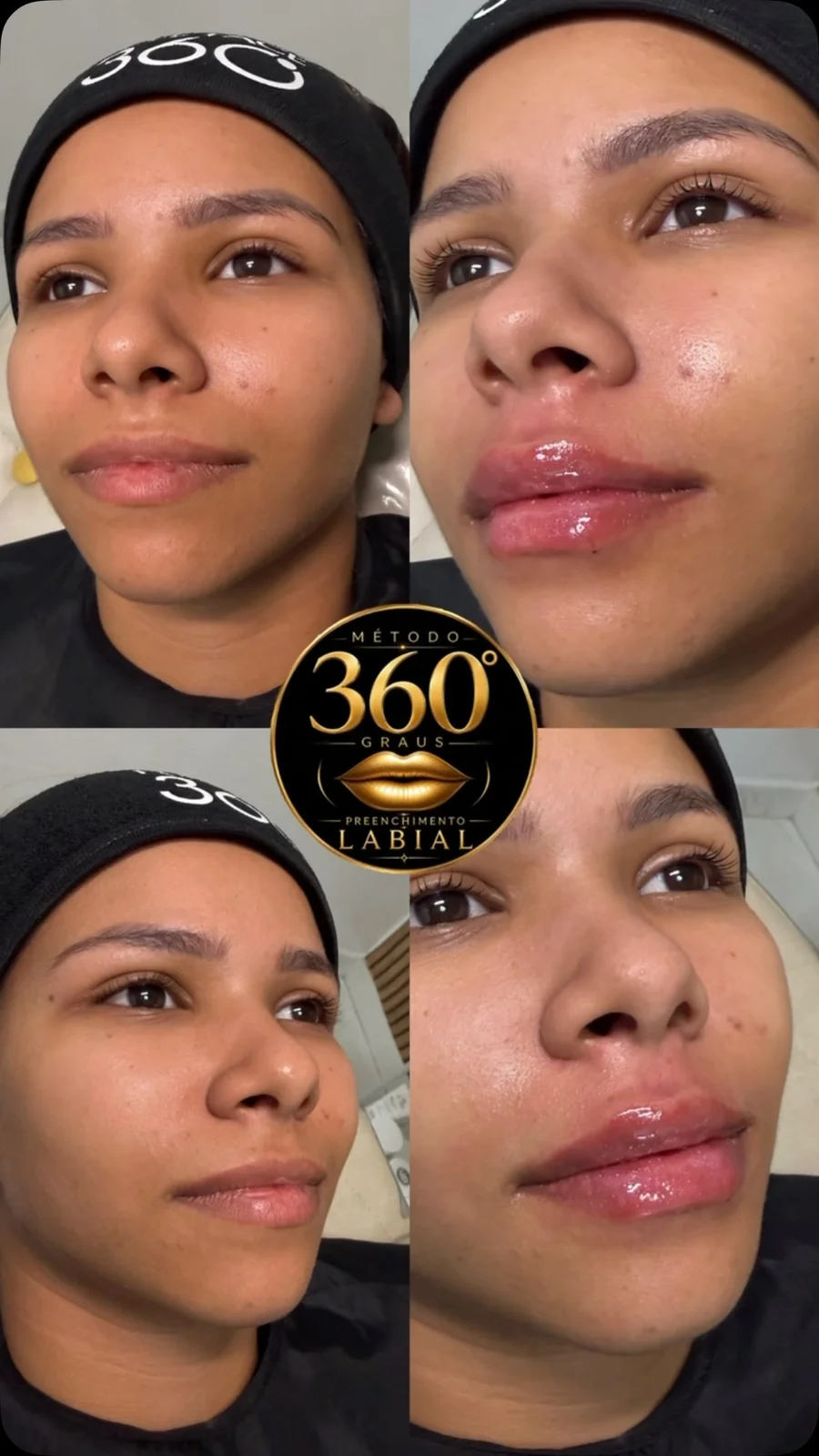 Antes e depois de harmonização labial
