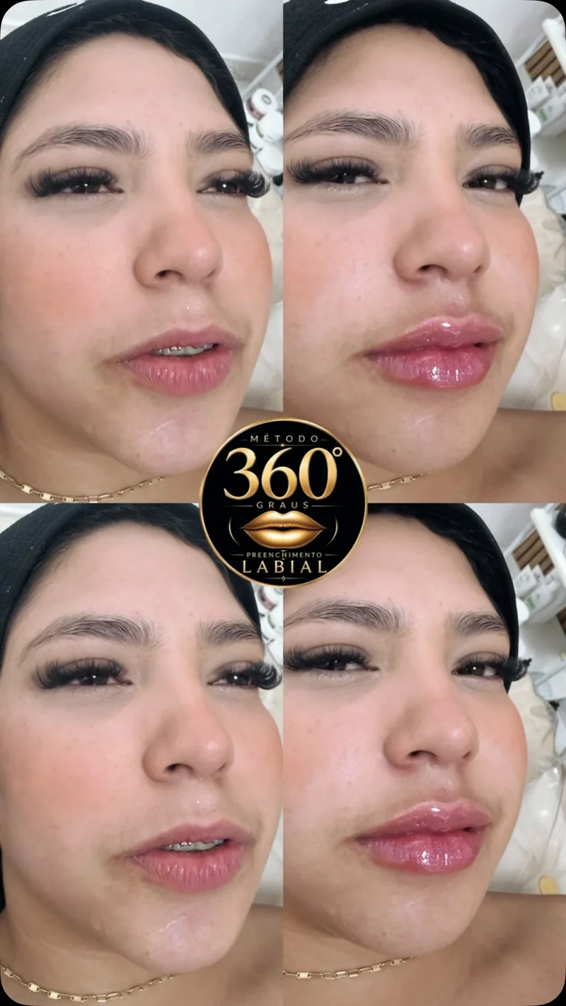 Antes e depois de harmonização labial