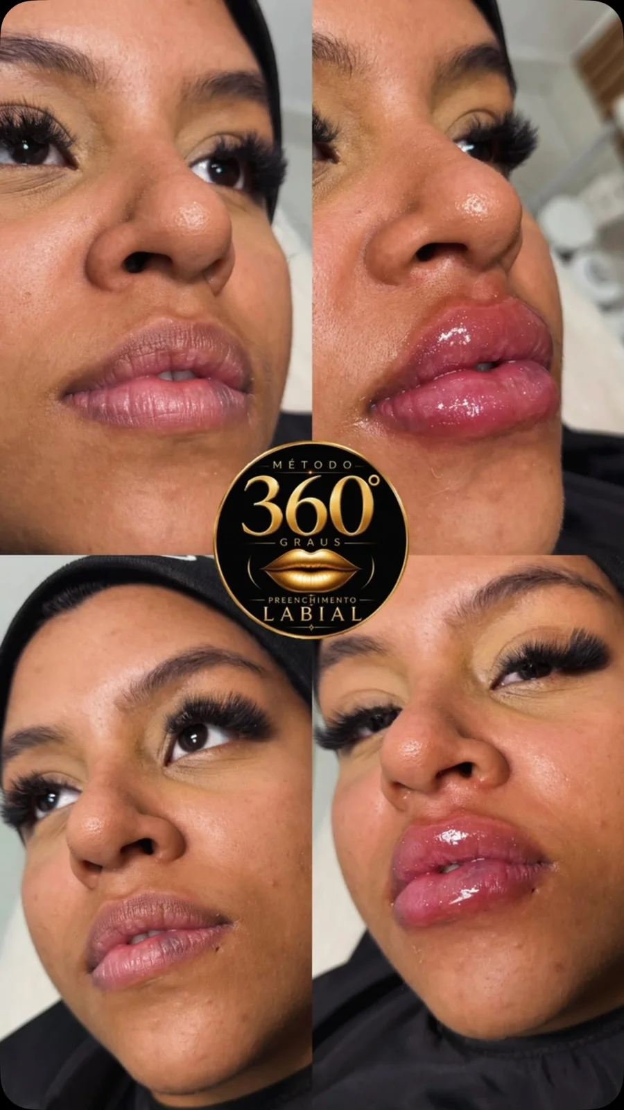 Antes e depois de harmonização labial